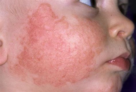 Atopic dermatitis on the cheek of a child