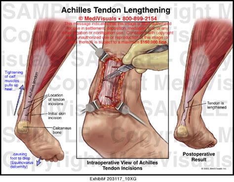 Achilles Tendon Lengthening Medical Illustration Medivisuals