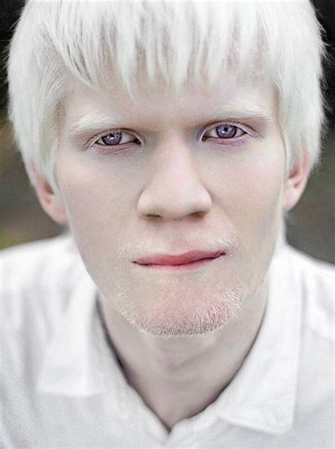 Albinism in humans Pictures – 26 Photos & Images / illnessee.com