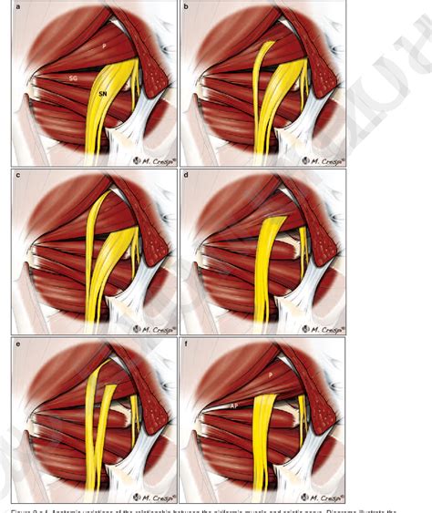 Figure 2 from Deep gluteal space problems: piriformis syndrome, ischiofemoral impingement and ...