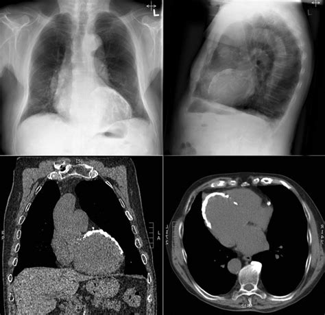 Cardiac and Vascular Calcification | Plastic Surgery Key