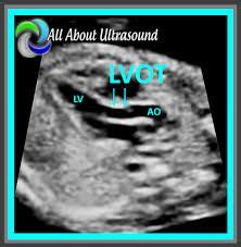 Image result for lvot ultrasound | Sonography school, Ultrasound, Sonography