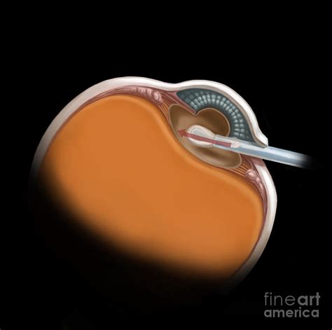 Lens Replacement Surgery Photograph by Spencer Sutton - Pixels