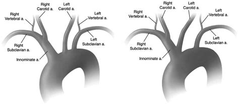 (A) The normal aortic arch branching pattern with separate origins for... | Download Scientific ...