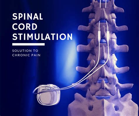 Spinal Cord Stimulation : University Pain and Spine Center: Interventional Pain Management Physician