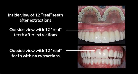 Bionic Smile $11,900 Full Arch Implants | 25 Year Limited Warranty