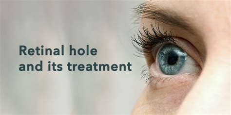 Retinal Hole Causes, Symptoms, and Treatment Options