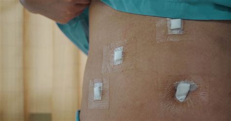 Gallbladder Surgery Scars: Healing and Sleep Tips