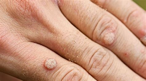 A wart can affect your professional life - so have yours removed!