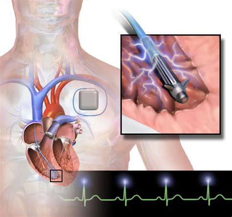 Cardiac Defibrillator - Baltimore Cardiologists - Woodholme Cardiovascular Associates