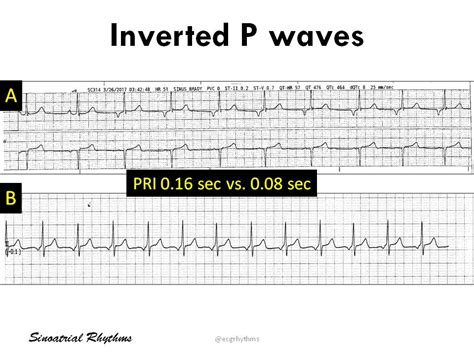 Inverted P Waves: (A) Ectopic atrial rhythm (B) Junctional ... | GrepMed