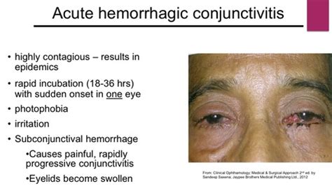 Acute Hemorrhagic Conjunctivitis