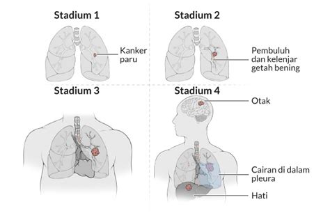 Diagnosis Kanker Paru-Paru - Alodokter