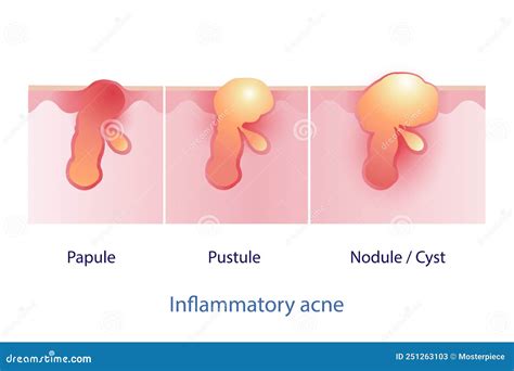 Types of Inflammatory Acne, Papule, Pustule, Nodule and Cyst Vector on ...