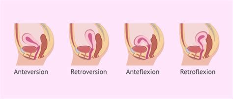 Are there any special considerations for IVF if I have a retroverted uterus?