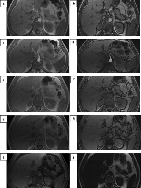 A 56-year-old woman with an incidentally discovered lipid-poor right... | Download Scientific ...