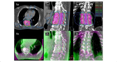 Cone Beam Ct In Radiotherapy - The Best Picture Of Beam