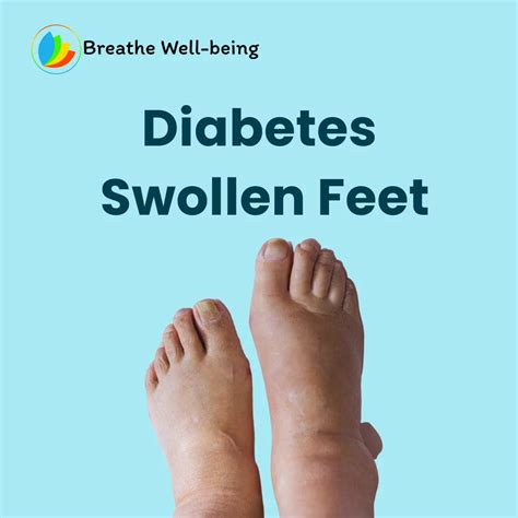 What is Diabetes Swollen Feet? Factors in Diabetes and Swollen Feet| - Breathe Well-Being