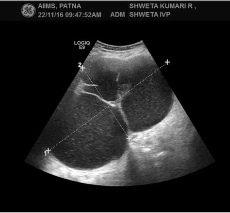 19.5 x 11.3 cm septated ovarian cyst. | Download Scientific Diagram