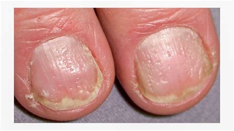 Pin on common nail disorders and diseases