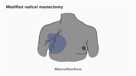 Mastectomy Anatomy