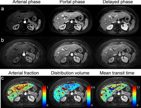 Free-breathing liver perfusion imaging using 3-dimensional through-time spiral generalized ...