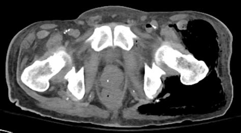 Gas Gangrene Associated With Clostridium septicum Infection | Consultant360