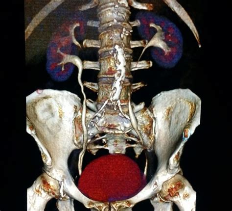 CT urogram in 3D. #radiologist #radiology #kidney | Diagnostic imaging ...