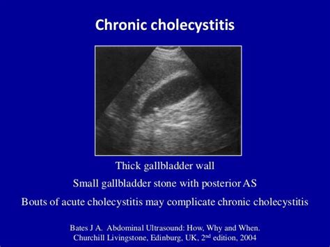 Chronic cholecystitis Bates J A. Abdominal Ultrasound: How, Why and ...