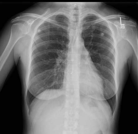 Atrial Septal Defect Closure Device