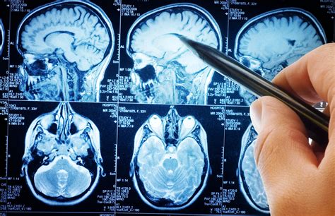 Tuberous Sclerosis | TSC | MedlinePlus