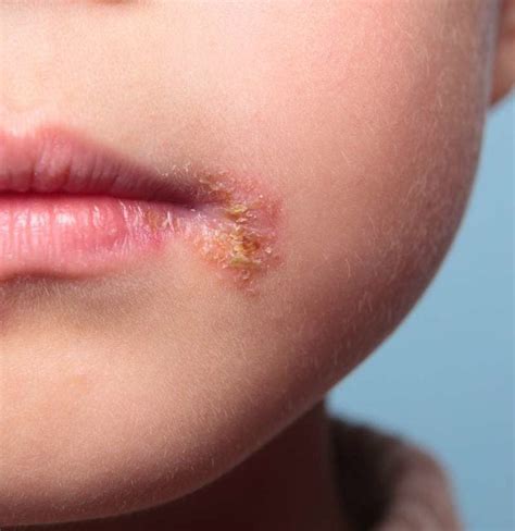 Can babies get cold sores? Causes, treatment, and risks