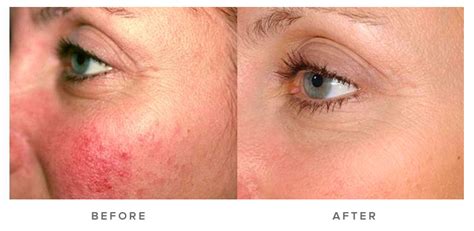 Laser Genesis Sydney | Laser Resurfacing | Infinity Skin Clinic