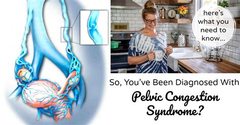 You've Been Diagnosed With Pelvic Congestion Syndrome... What Now?