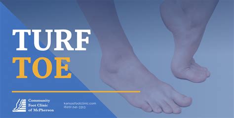 Comprehensive Turf Toe Treatment | Community Foot Clinic of McPherson