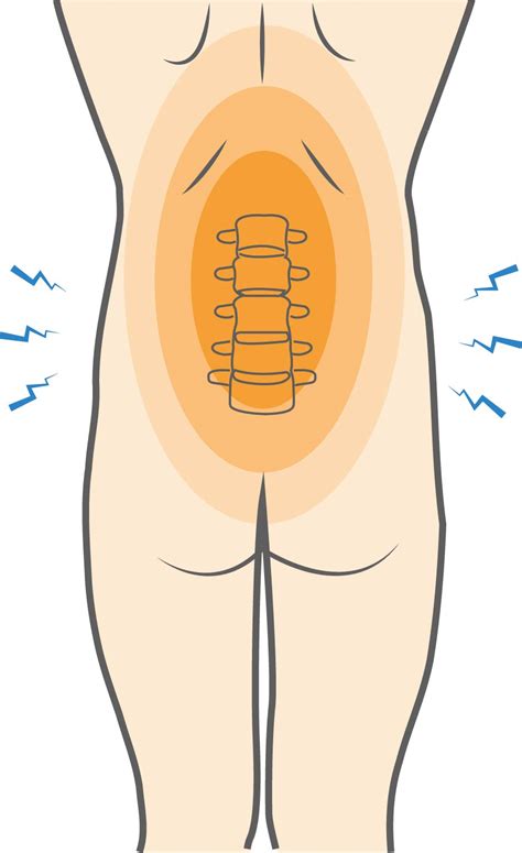 What is a Low Back Contusion (Bruise) & How to Recover? - Upswing Health