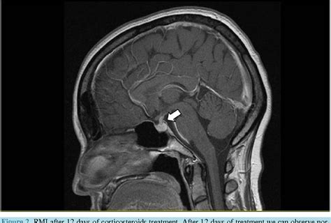 Figure 1 from A Case Report of Lymphocytic Hypophysitis Related to Pregnancy | Semantic Scholar