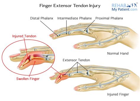 Extensor Tendons Hand Anatomy