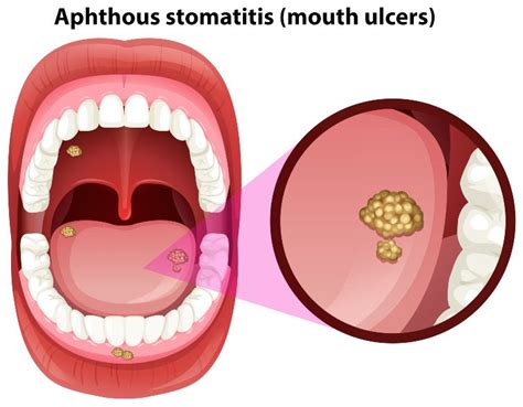 Unique Info About How To Cure An Ulcer In The Mouth - Petertrade29