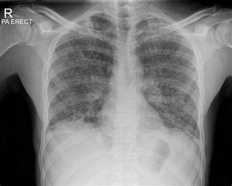 Chest X Ray Miliary Tb