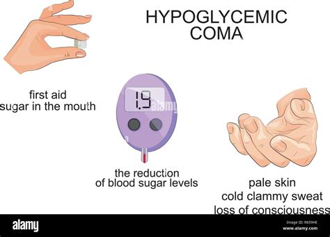 illustration of symptoms and hypoglycemic coma. infographics Stock Vector Image & Art - Alamy