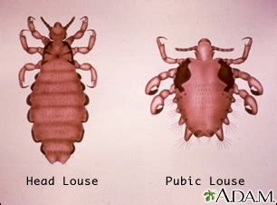 Pubic lice Information | Mount Sinai - New York