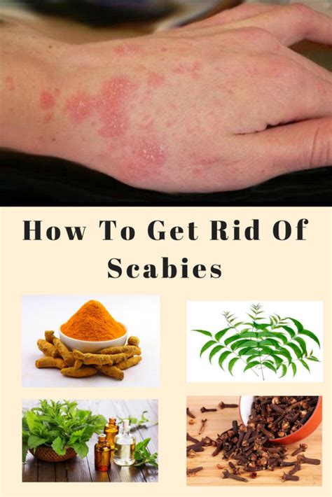 Best Home Remedies To Get Rid Of Scabies | Scabies, Home remedies for ...