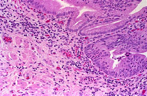 Duke Pathology 750 - Inflammation and Tissue Repair