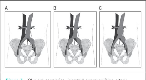 Figure 2 from Survey of management of common iliac artery aneurysms by ...