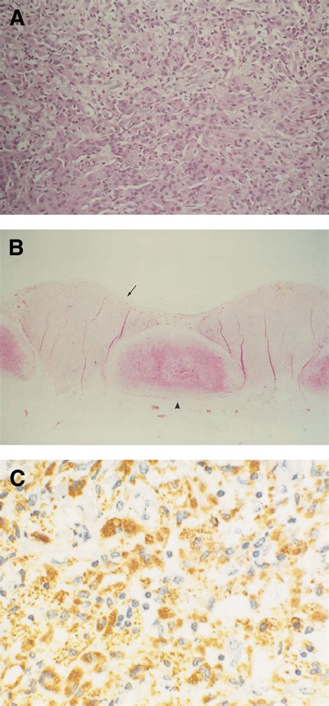 (A) Section of skin showing mixed cellular infiltrate composed of pale ...