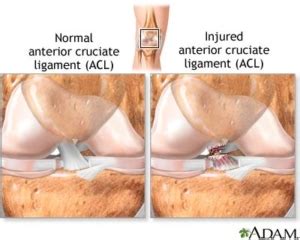 ACL Surgery and Reconstruction in Illinois | Dr. Roger Chams