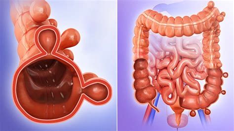 All Diverticulitis Articles