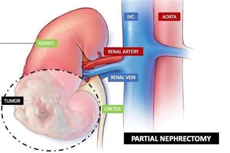 Nephrectomy | Kidney Removal | What Is Laparoscopic Nephrectomy