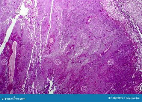 Caseation of Human Tuberculosis Granuloma, Light Micrograph Stock Image ...